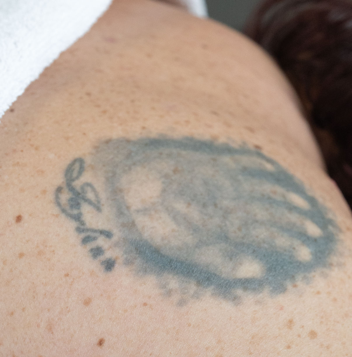 Tatoeage weghalen met laser Tatoeage weghalen met laser